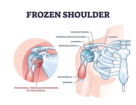 Frozen Shoulder Symptoms, Causes & Treatments | Advanced Surgery Center