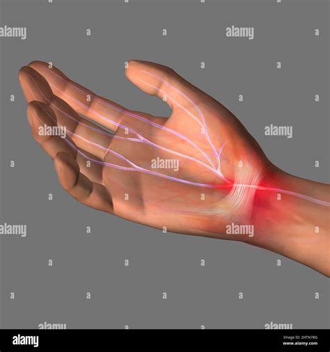 Carpal Tunnel Syndrome Illustration Stock Photo Alamy