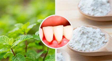 5 Home Remedies To Treat Gingivitis Naturally Daily Health Valley