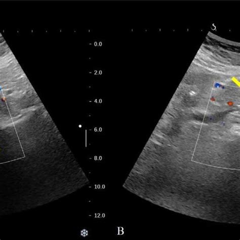 -Leriche syndrome: color Doppler showing hypoechoic plaque within the ...