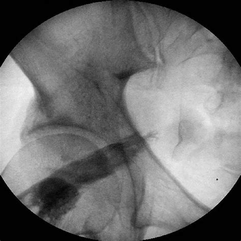 MRI Axial T1 Weighted Image Showing Asymmetry Of The Piriformis