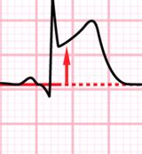 Chest Pain And Acute Coronary Syndrome Flashcards Quizlet