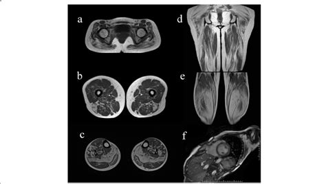 Lower Leg Muscle And Cardiac MRI Characteristics In NLSDM Patients A