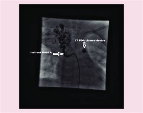 A large tortuous collateral from thoracic aorta to the right subclavian... | Download Scientific ...