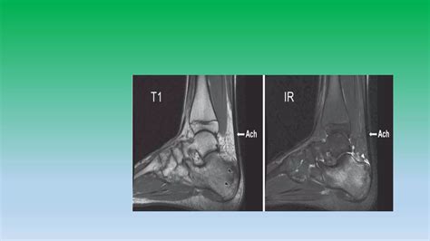 Mri anatomy of ankle radiology ppt pk | PPT