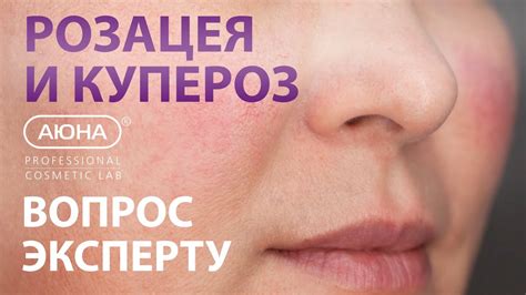 КУПЕРОЗ и РОЗАЦЕА: вопрос эксперту косметологу-дерматологу | УЦ АЮНА ...