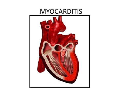 Myocarditis Carditis