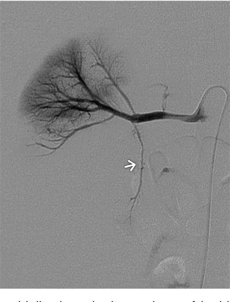 Figure From Transarterial Embolization In The Management Of