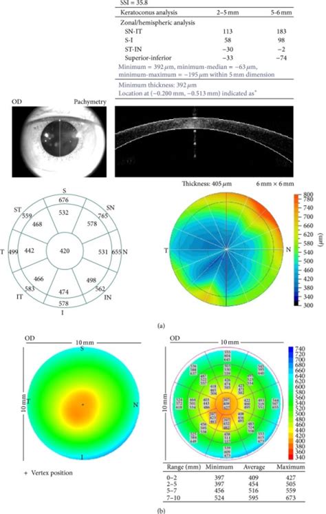 Corneal Pachymetry Conversion Chart