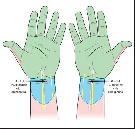 median nerve block | Semantic Scholar