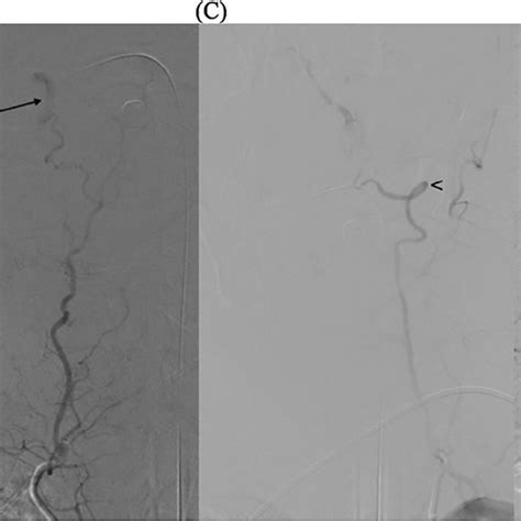 Right Vertebral Artery Ostium Occlusion Arrow A Right Vertebral