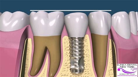 Ajuste Oclusi N Con Implantes Cl Nica Dental New York Style Barber