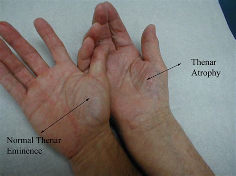 What Is Carpal Tunnel Lattimore Physical Therapy