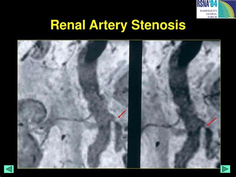 Ppt Mri Atlas Of Renal Pathology Powerpoint Presentation Free