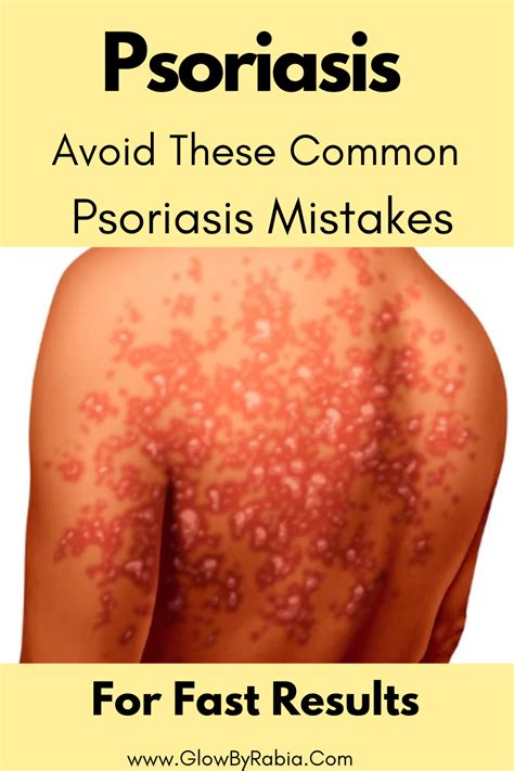 What Is Psoriasis Symptoms Causes Diagnosis Treatment And Prevention Artofit