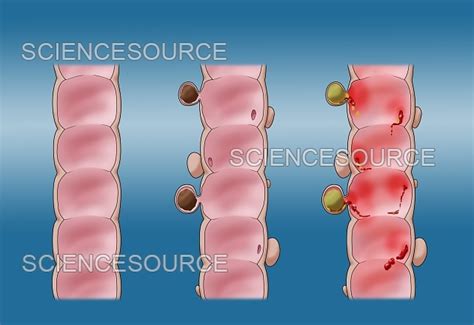 Comparison Of Diverticulosis And Diver Stock Image Science Source