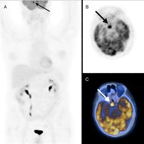 Maximum Intensity Projection Images Mip A Showing A Focal Increased