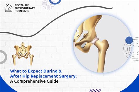 What To Expect During And After Hip Replacement Surgery A Comprehensive