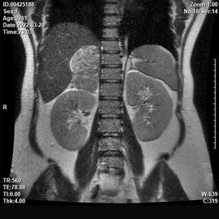 MRI Of The Urinary System Showed A Mass In The Right Adrenal Gland With