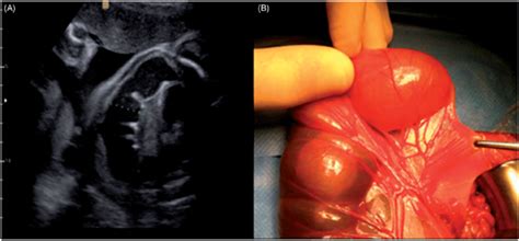 Jejunal Atresia A Dilated Small Bowel Proximal To Jejuneal Atresia