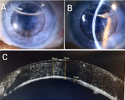 Central And Bullous Descemet Membrane Detachment During Cataract Wound Hydration An Insightful