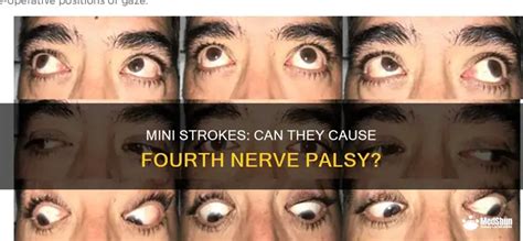 Mini Strokes Can They Cause Fourth Nerve Palsy Medshun