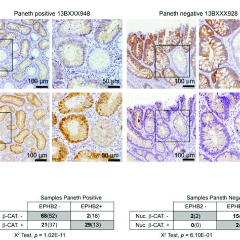 Expression of EPHB2 is linked with Wnt β catenin activation in Paneth