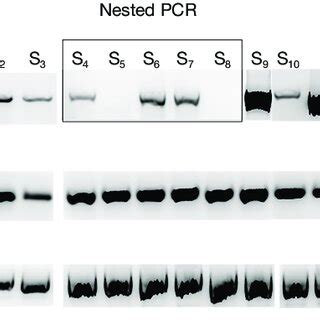 Expression Of Ncam And Kda Variants In Cancer Cell Lines And