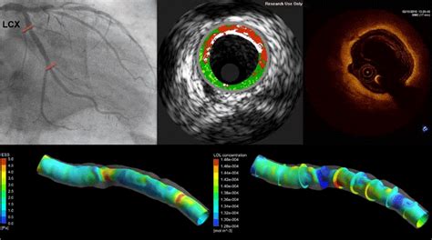 Prediction Of Atherosclerotic Plaque Development In An In Vivo Coronary