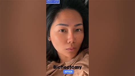 Bichectomy Before and After | Buccal Fat Removal in Turkey | Cheeks ...