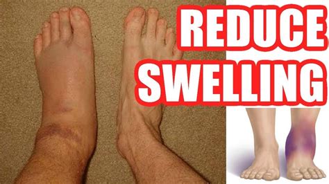 How To Reduce Swelling Make Your Swelling Go Down Easy Methods Youtube