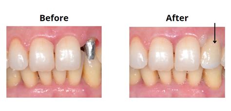 What types of dental crowns are best for you?