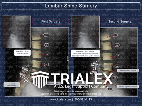 Lumbar Spine Surgery - TrialExhibits Inc.