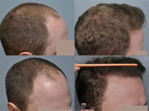 Androgenic Alopecia Cooley Hair Center