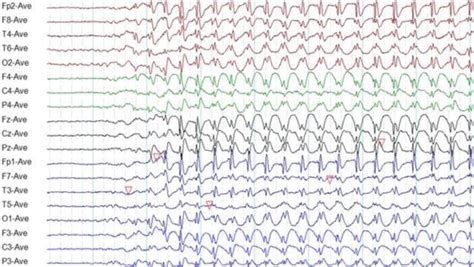 Basic Electroencephalogram And Its Common Clinical Applications In