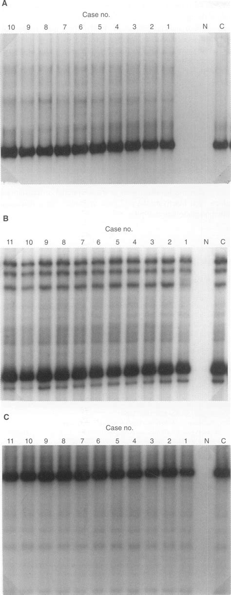 A Pcr Sscp Analysis Of The Ela Segment Of The P21 Gene Non Glycerol