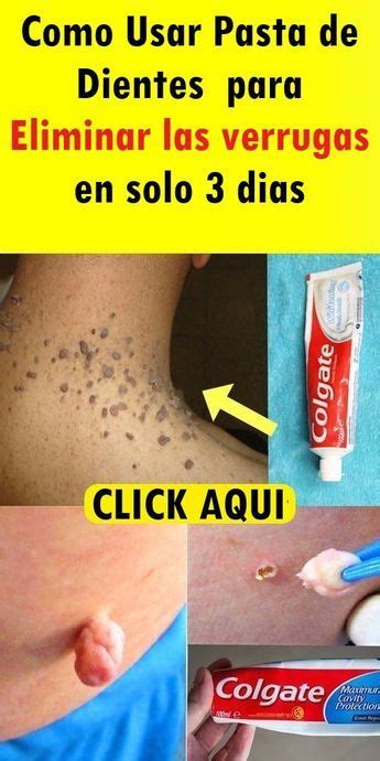 Como Eliminar Las Verrugas Del Cuello Con Estos Remedios Caseros Artofit