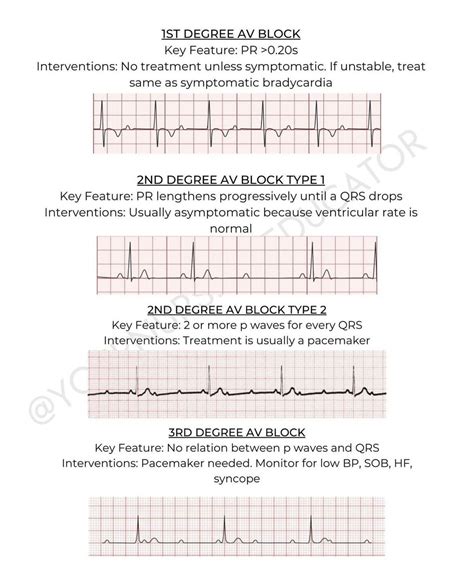 Ekg examples pdf electrocardiography cardiovascular system – Artofit