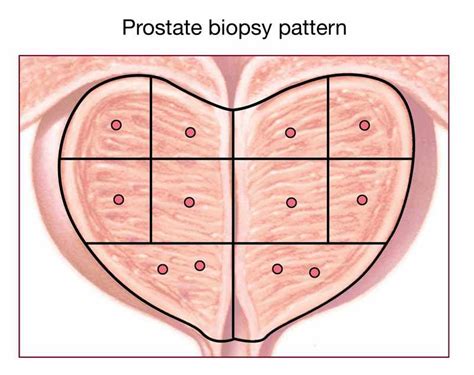 What Is Involved In A Prostate Biopsy