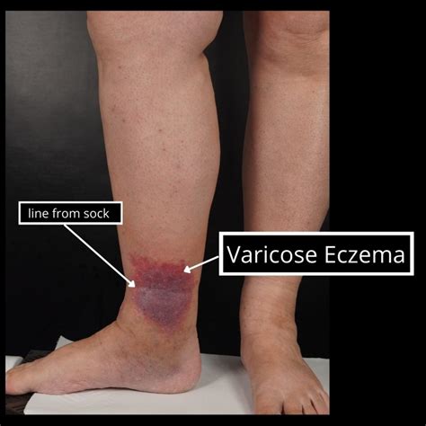 Is Varicose Eczema Curable The Veincare Centre