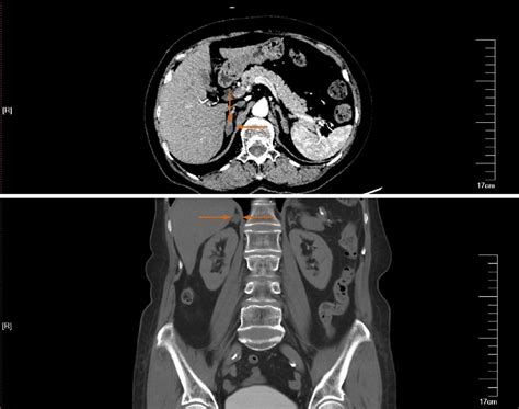 Figure 2 From Retroperitoneal Laparoscopic Partial Resection Of The