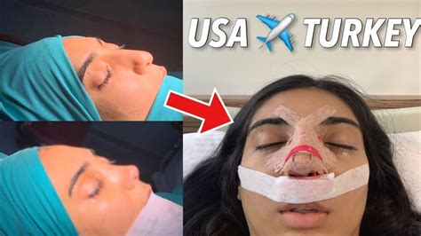 I FLEW TO TURKEY TO GET A NOSE JOB VLOG YouTube