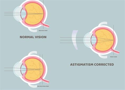 Understanding 025 Astigmatism: Causes, Symptoms & Treatment