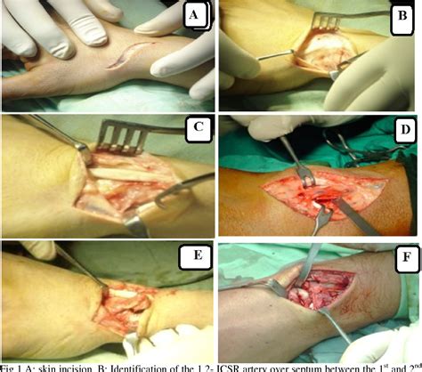 Figure 1 From Vascularized Pedicle Dorsal Distal Radius Graft In