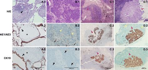 Haematoxylin Eosin Pan Keratin Ae Ae And Krt Expression In