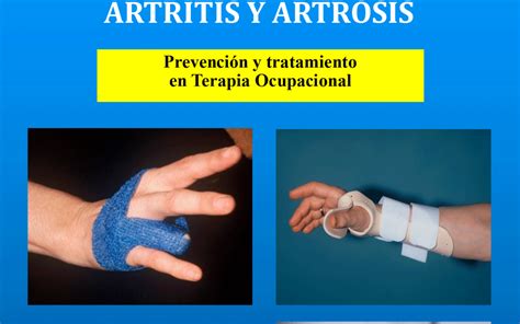 Reseña Libro Rehabilitación Funcional De Las Manos Con Artritis Y