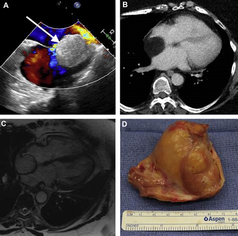 An Electrophysiological And Anatomical Space Occupying Lesion