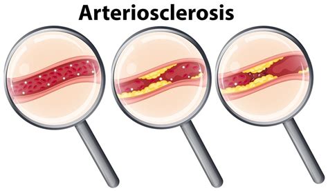 Symptoms of arteriosclerosis - Diabetes and coronary artery disease