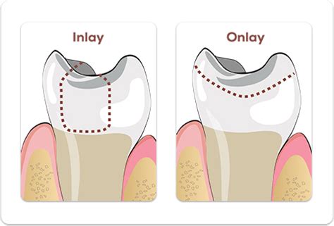 Inlays and Onlays, Newark and Bear Dentist