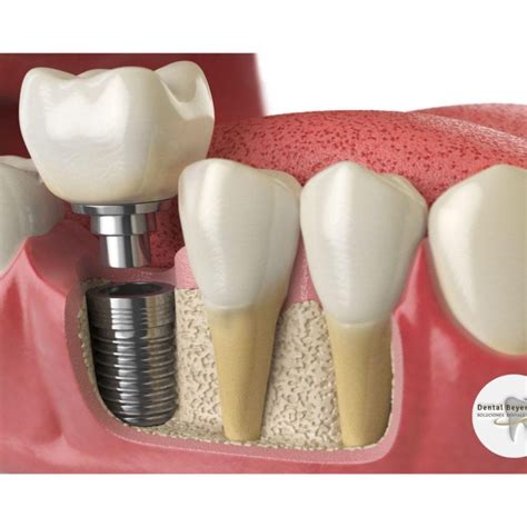 Complicaciones de los implantes dentales cuáles son las más